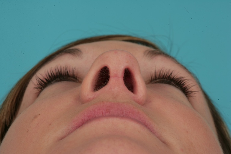 Nasal Base Postop