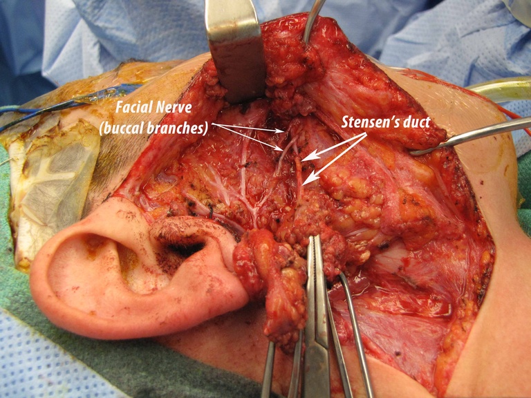 020 parotid 092009.jpg