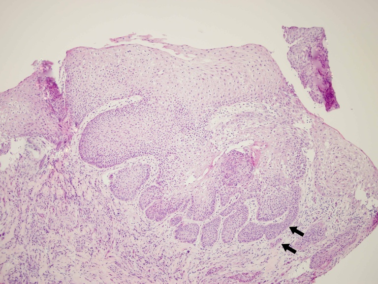 Intermediate magnfication of a frozen section (intraoperative consultation) of a laryngeal biopsy showing an expansile tumor with infiltrating buds of atypical squamous cells (black arrows) invading the submucosa.