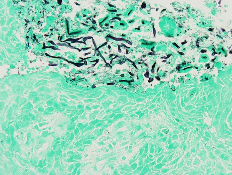 Grocott Methenamine Silver (GMS) stain showing several candidal pseudohyphae within the surface exudate. This finding may be more accurately described as colonization and may not require antifungal treatment.