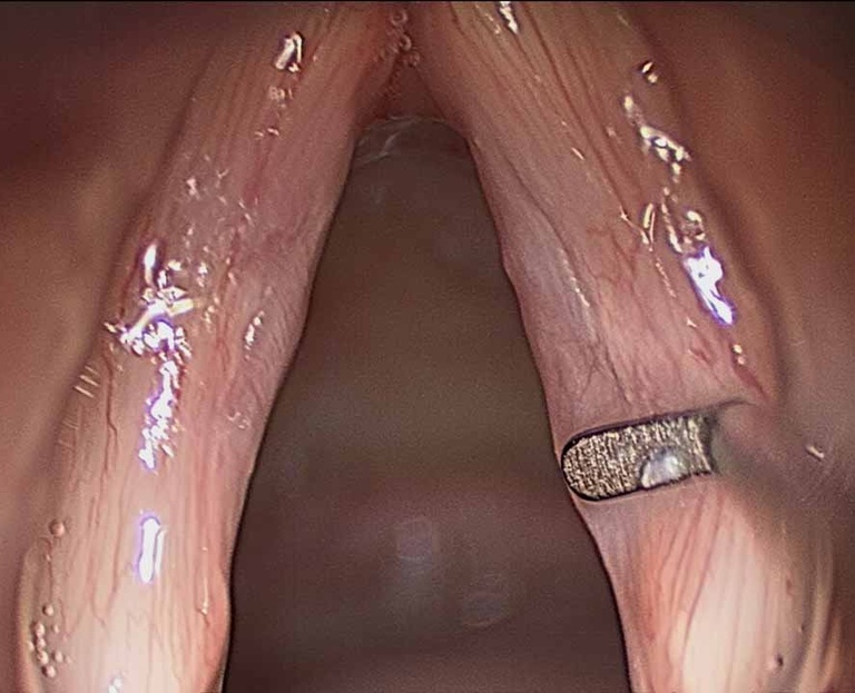020%20sulcus.jpg