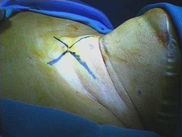 Four-flap epithelial lined tracheotomy outlined (with anterior cervical lipectomy and thyroid isthmusectomy)