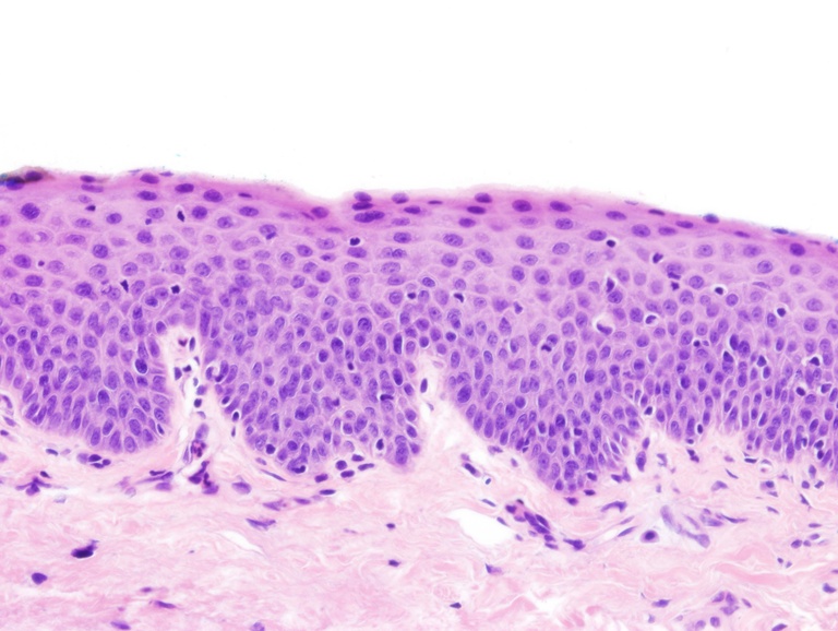 Moderate squamous dysplasia of right vocal cord