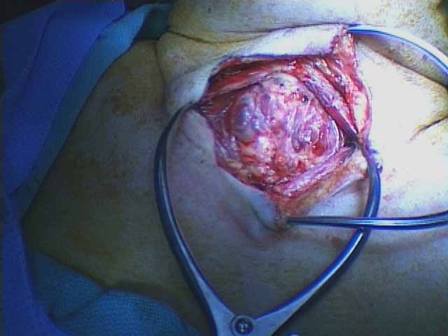 Two gelpy retractors used to identify large multinodular goiter after anterior cervical lipectomy accomplished along with midline separation of strap muscles