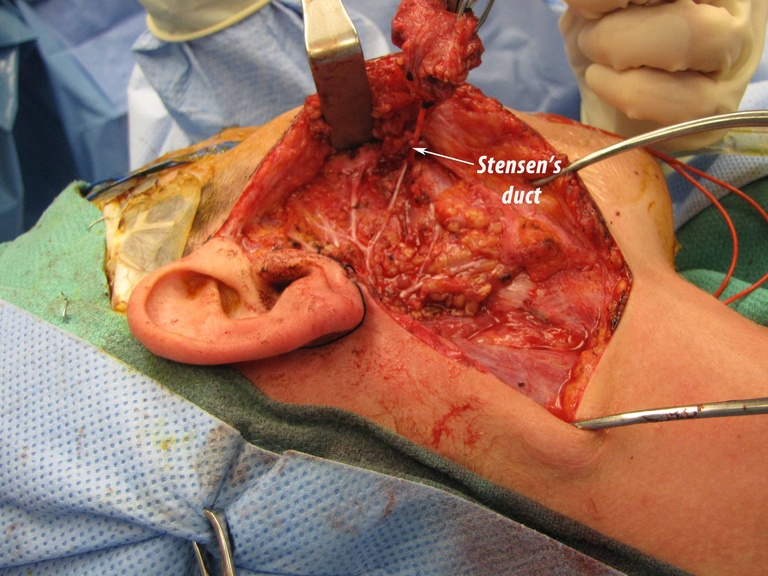 022 parotid 092009.jpg