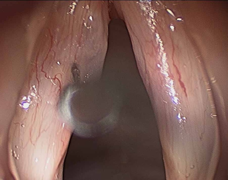 022%20sulcus.jpg