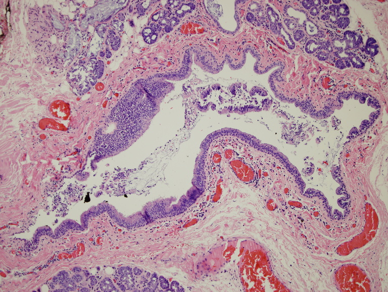 023%20Laryngocele%20100x.jpg