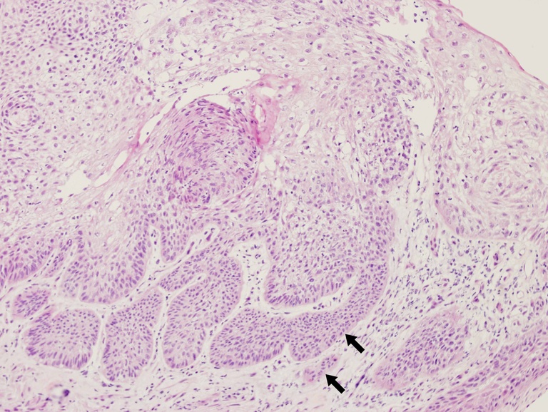 High magnification of the prior biopsy showing irregular nests and tongues of malignant cells (black arrows) invading the superficial submucosa.