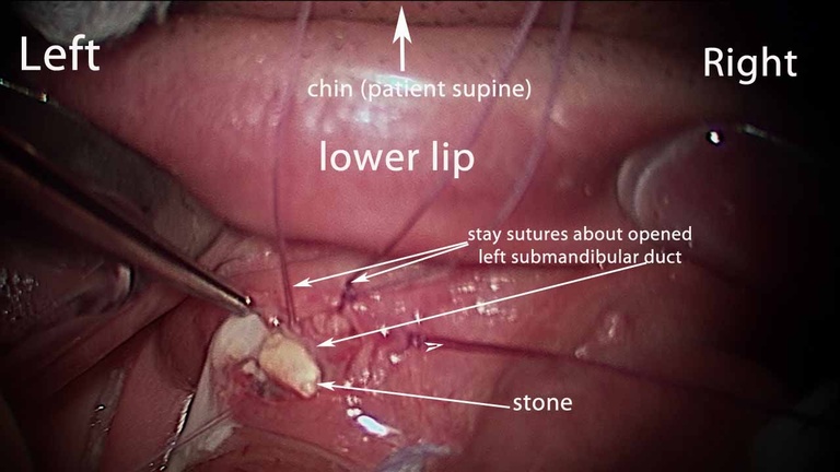 023%20orientation%20for%20stone%20removal.jpg