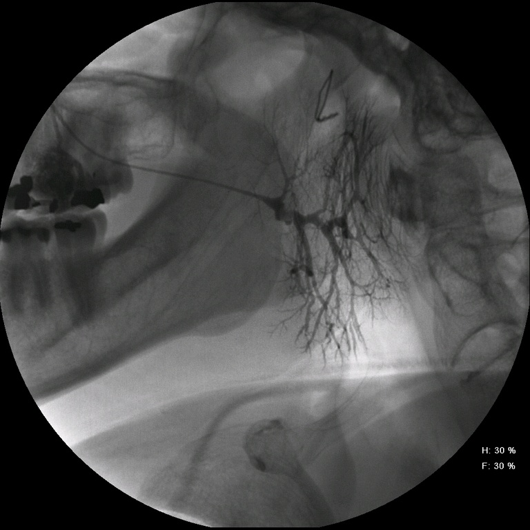 1 Instillation of Isovue Contrast with 22 Gauge Angiocath