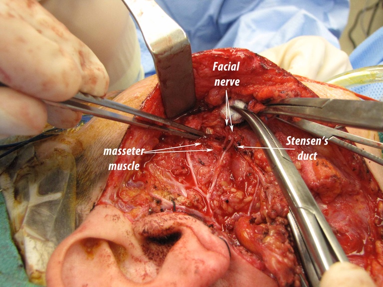 024 parotid 092009.jpg