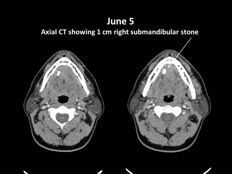 024%20composite%20CT%20stone.jpg