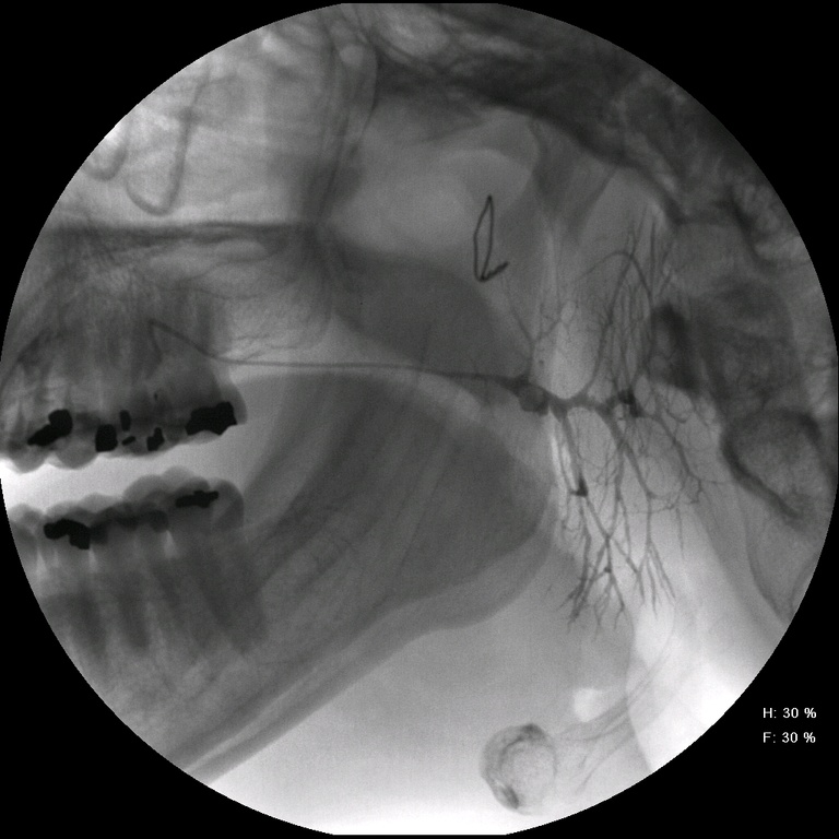 2 After removal of angiocatheter