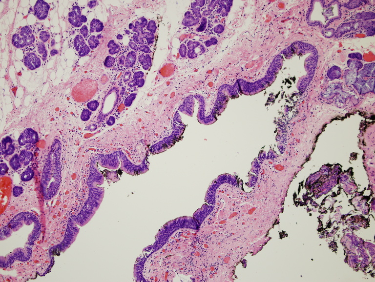 025%20Laryngocele2%20100x.jpg