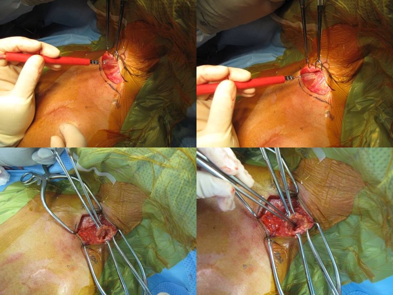 Resection of heterotopic bone Nerve stimulator to preserve spinal accessory