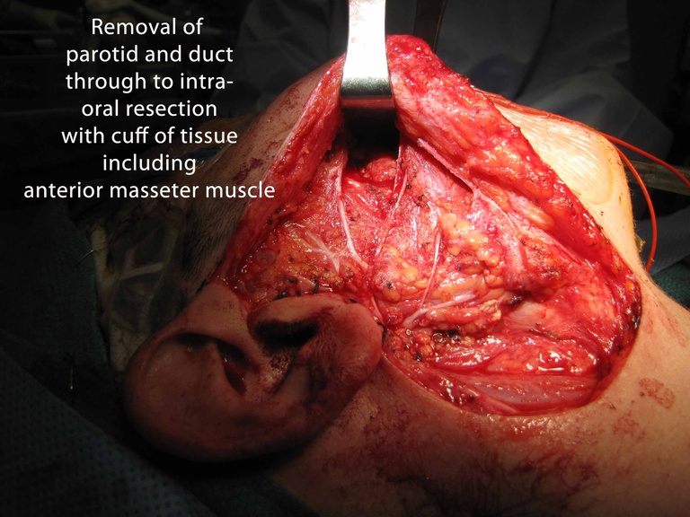 026 parotid 092009.jpg