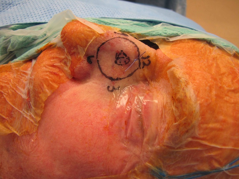 027%20arm%20face%20prep%20for%20resection.jpg
