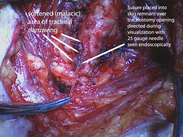 027%20trachstenosis%20.jpg