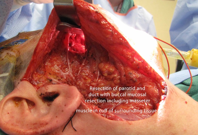 028 parotid 092009.jpg