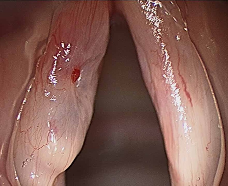 028%20sulcus.jpg