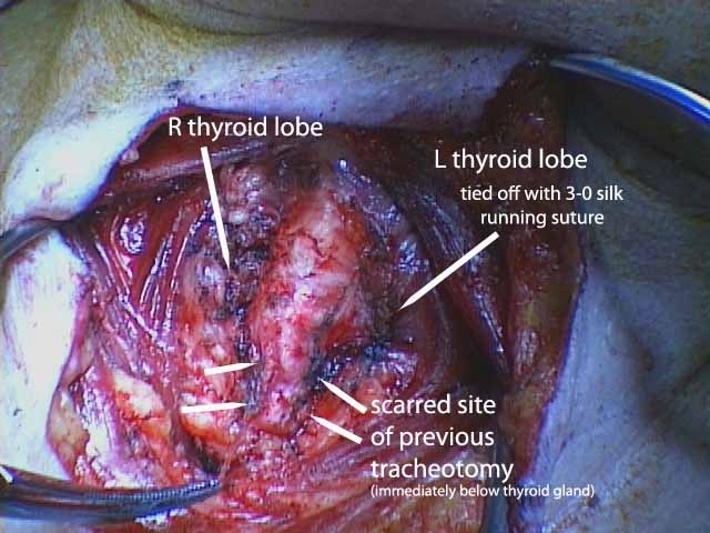 028%20trachstenosis.jpg
