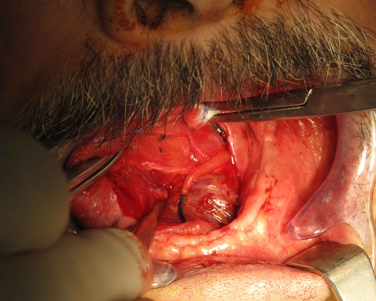 02ductoplasty%20b.jpg