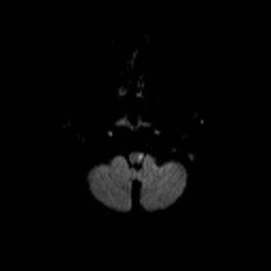 03 mri 122110 left lat medullary infarct.jpg