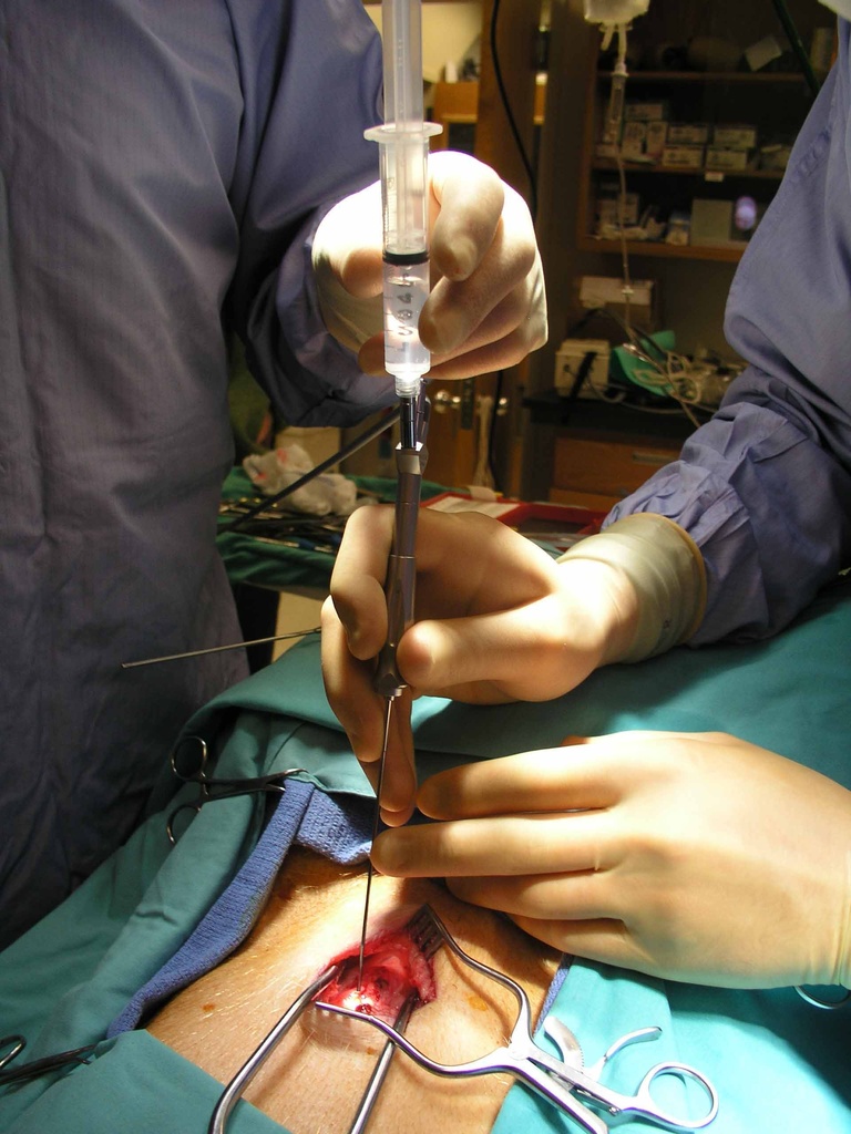 Sialendoscope in Reinke's space
