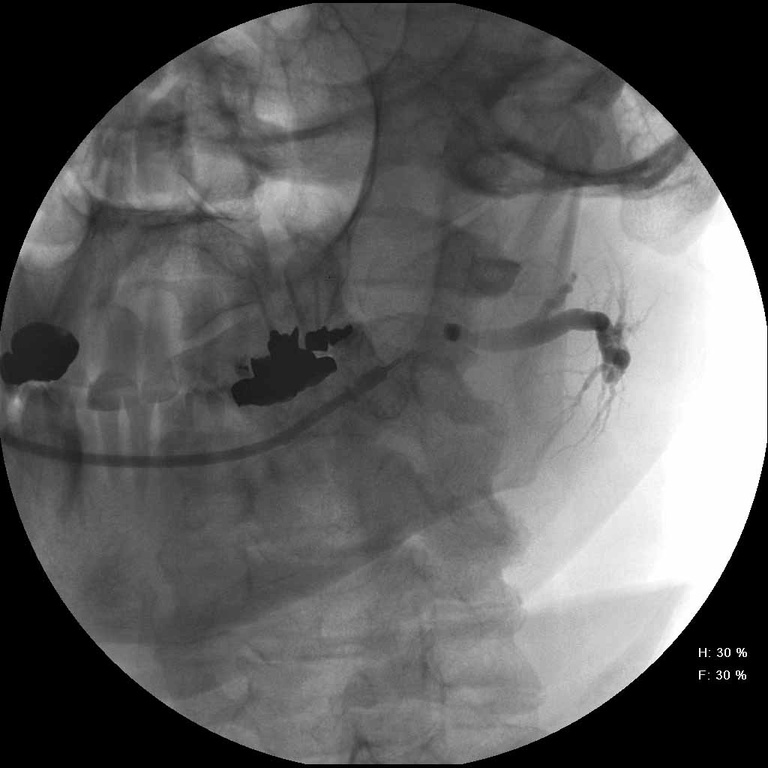L parotid sialogram with metallic density foreign boyd in midportion of duct