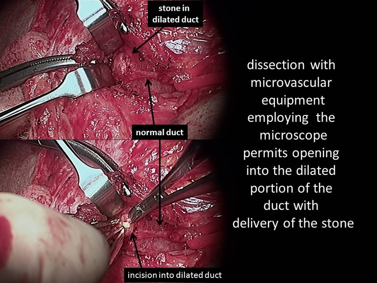 03%20open%20stone%20removal.jpg