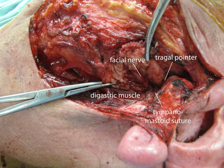 03%20parotid%20b.jpg