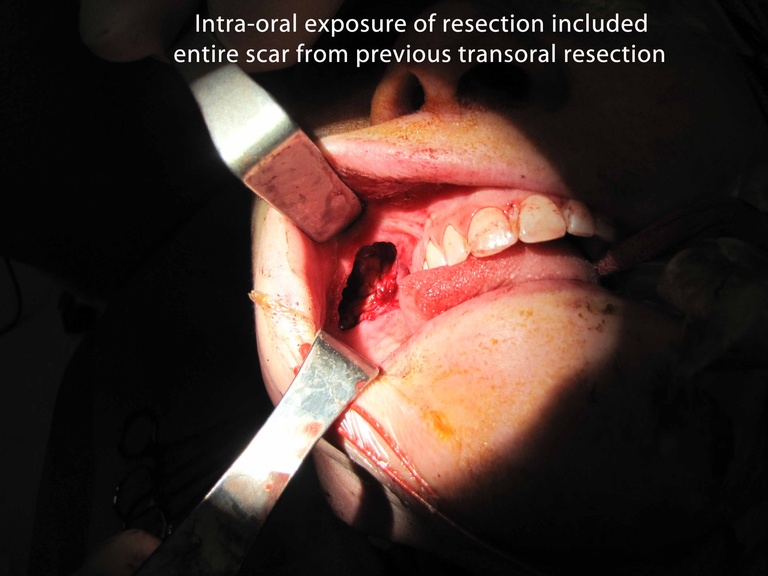 030 parotid 092009.jpg