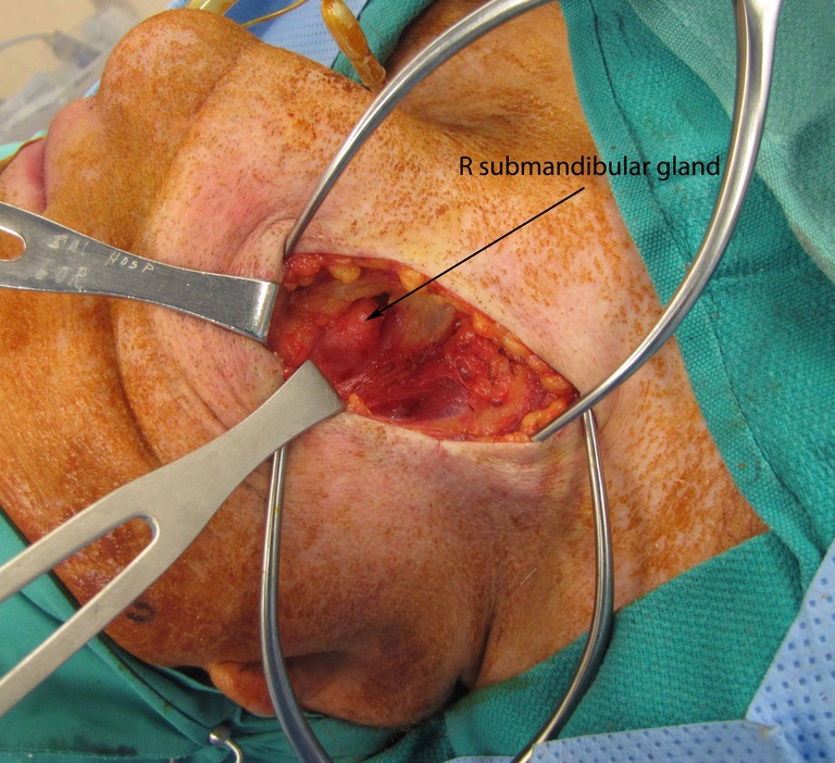 b Intraoperative exposure of gland