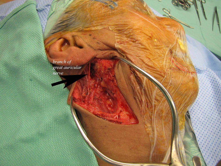 resection complete with preservation of great auricular nerve
