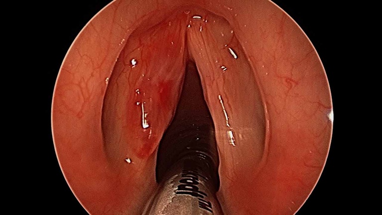 030%20sulcus.jpg