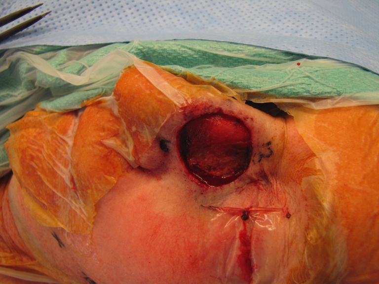 031%20ftsg%20resection.jpg