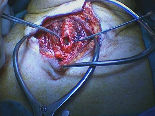 031%20trachstenosis.jpg