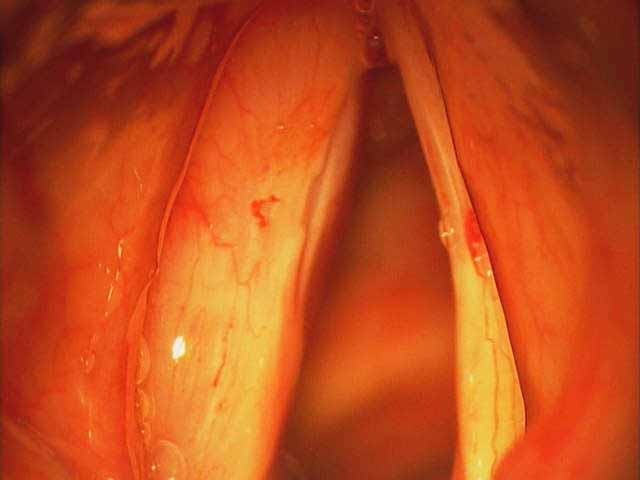  examination with microscope during laryngoscopy   palpation of vocal fold during direct laryngoscopy   palpation of vocal fold during direct laryngoscopy 
