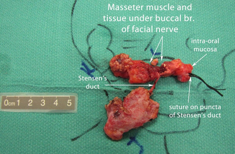 032 parotid 092009.jpg