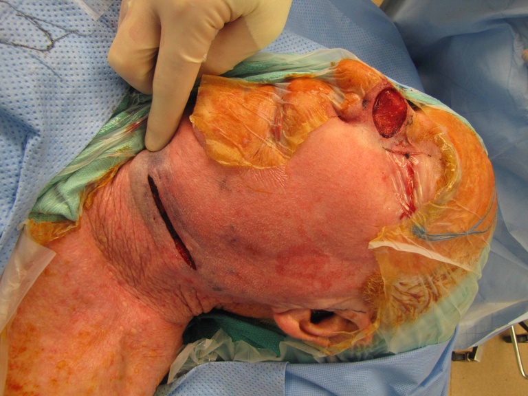 032%20ftsg%20resection%20with%20sln%20bx.jpg