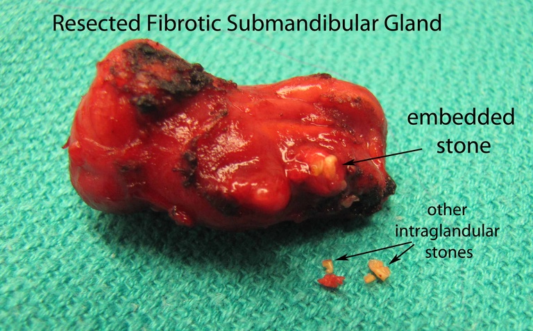 c. Resected Gland
