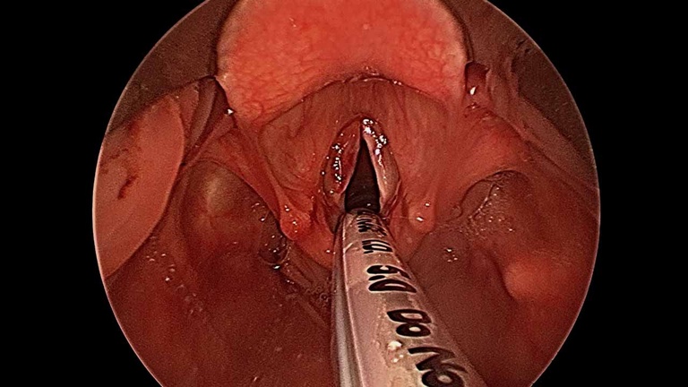 032%20sulcus.jpg