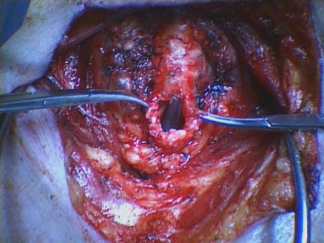 032%20trachstenosis.jpg
