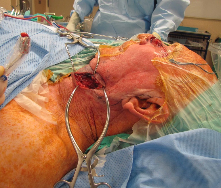 033%20ftsg%20resection%20with%20sln%20bx.jpg