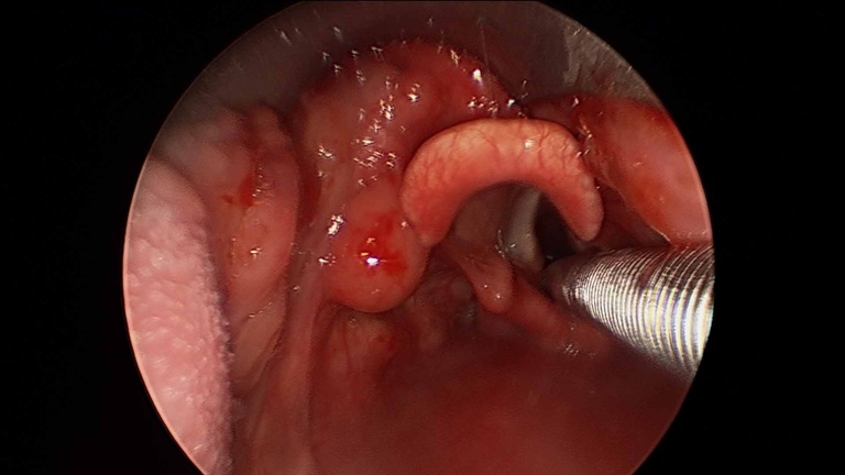033%20vcyst.jpg