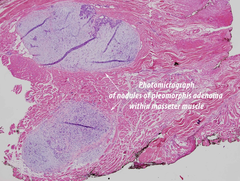 034 parotid 092009.jpg