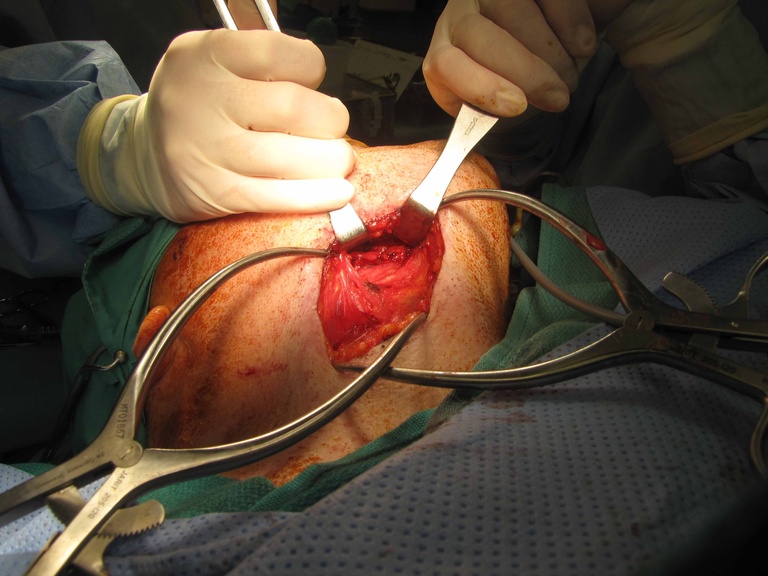 d. Appearance of wound after gland and stone removal