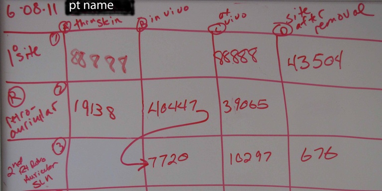 Final analysis of "site after removal" activity of 676 identifies a decrease from 40,447 (676/40,447 x 100 =1.7% activity) - confirming removal of sentinel nodes. 