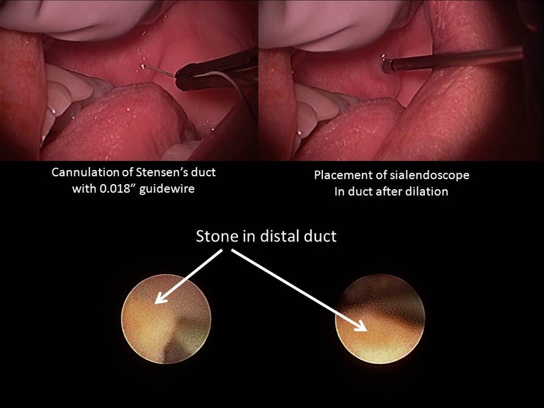 036 initial sialendoscopy.jpg