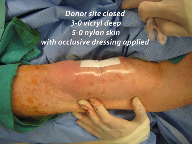 038%20ftsg%20donor%20site%20closure.jpg